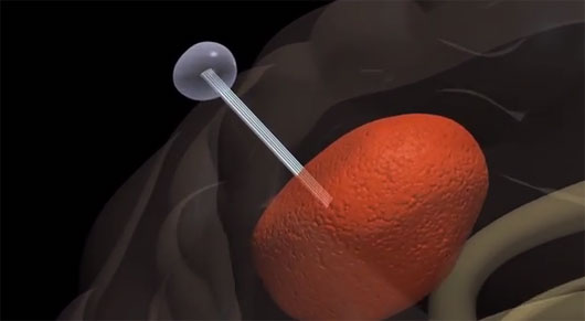 19022014 edaily uong nuoc sa chua ung thu 2