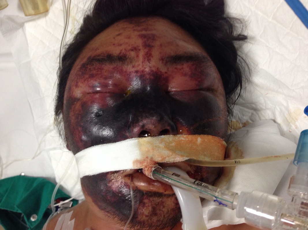 lien-cau-khuan-lon-1