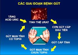 Thống phong hoàn - Xua tan hoàn toàn nỗi lo bệnh Gút